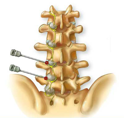 Radiofrequency Ablation or Rhizotomy: Cervical, Thoracic and Lumbar ...